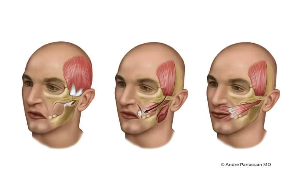 Three-stage medical illustration of lengthening temporalis myoplasty: the temporalis muscle is released from the jaw, redirected toward the corner of the mouth, and secured to restore a dynamic smile in facial paralysis patients