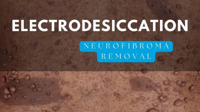 NF Surgeon Explains Electrodesiccation for NF1 Tumors